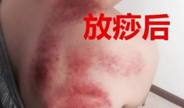 刮痧视频,健康生活新体验——揭秘刮痧视频中的养生奥秘